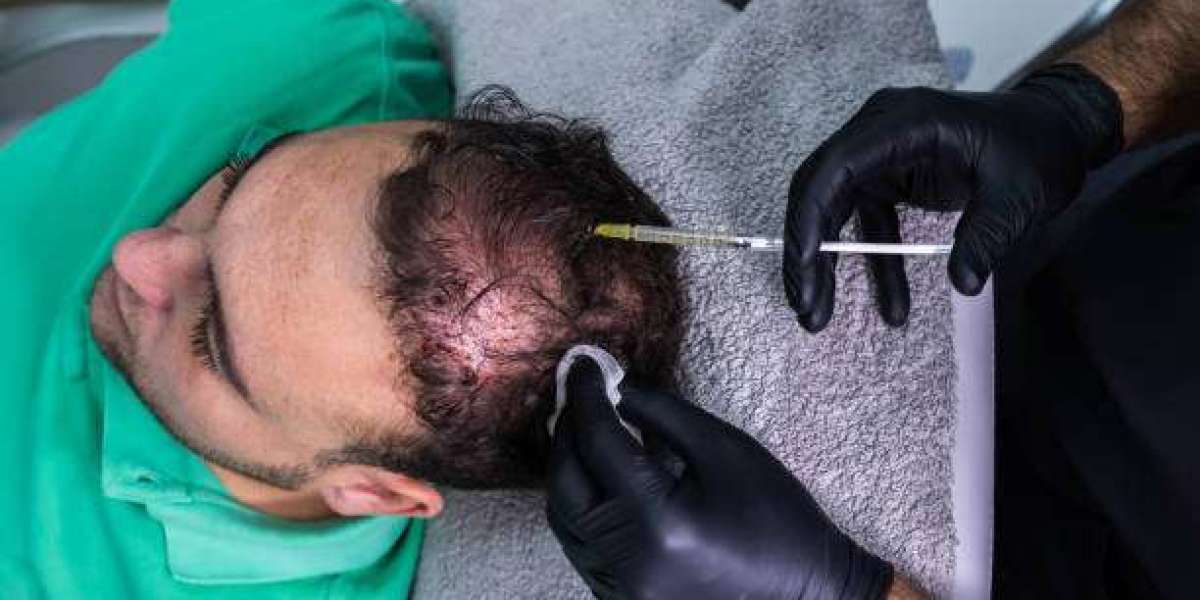 PRP Hair Treatment for Restoring Confidence Through Hair Growth