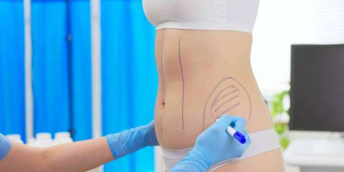 Liposuction and Its Role in Enhancing Physical Fitness