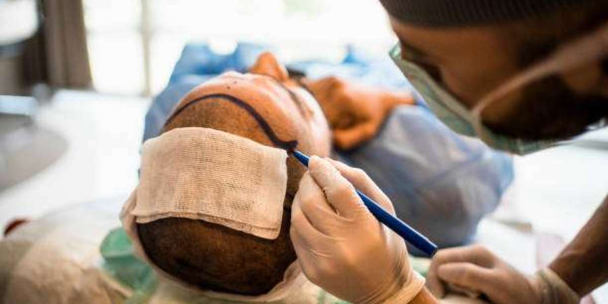 How Does Hair Transplant Contribute to Overall Hair Health?