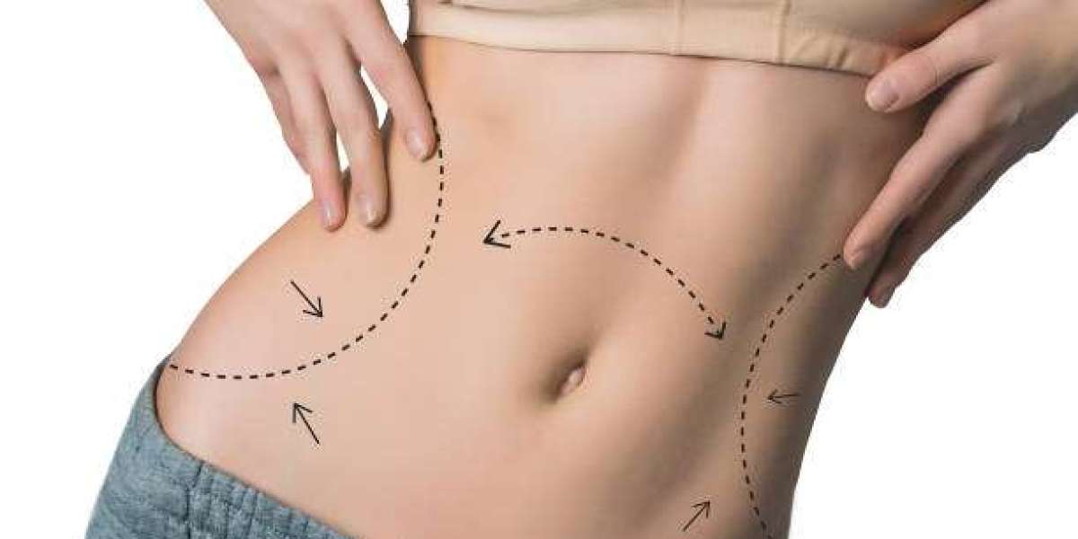 What to Expect Before Choosing a Body Sculpting Procedure