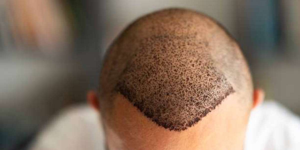 Hair Transplant: Regain Natural Hair Density and Volume