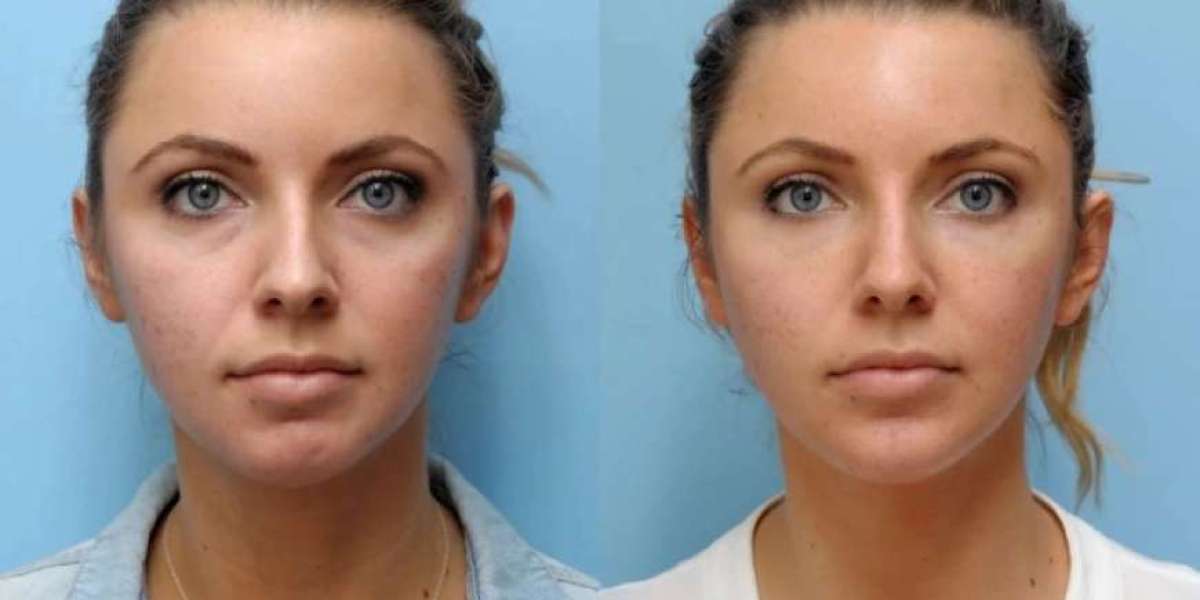 Botox for Nose in Dubai: Fast and Safe Results