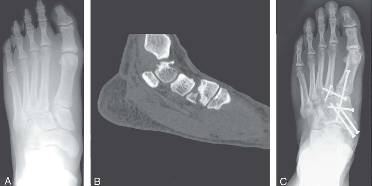 Fractures & Dislocations: Symptoms, Types and First Aid