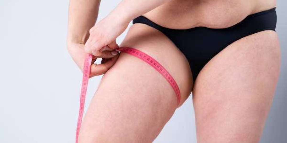 What Recovery Looks Like After Lipedema Liposuction?