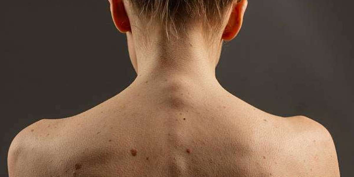 Latest Mole Removal Techniques for Smooth Skin