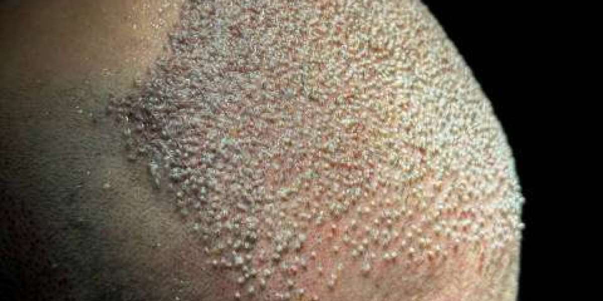 Comparing DHI Hair Transplant to Other Techniques in Riyadh