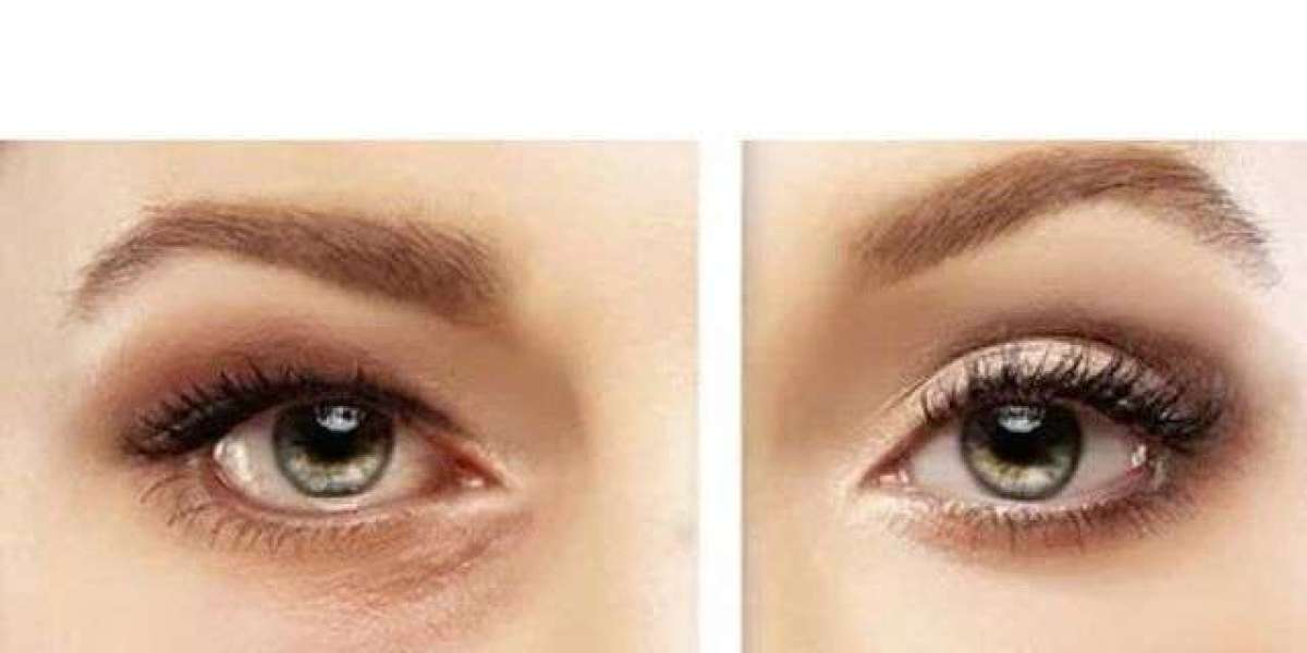 Eyelid Lift Surgery Benefits: Refresh Eyes and Reduce Tired Appearance
