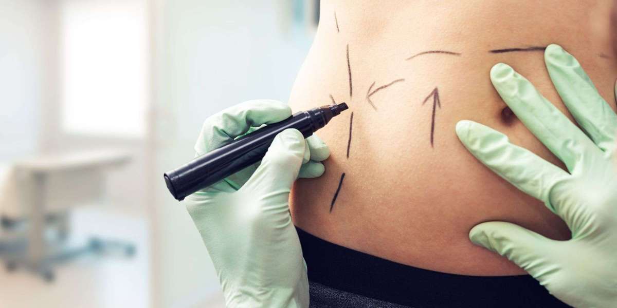 Exploring Safe Body Contouring Options Through Liposuction in Riyadh