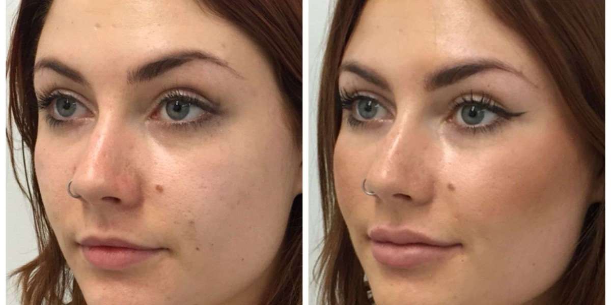 Natural Results with Facial Fat Grafting for Cheeks in Riyadh