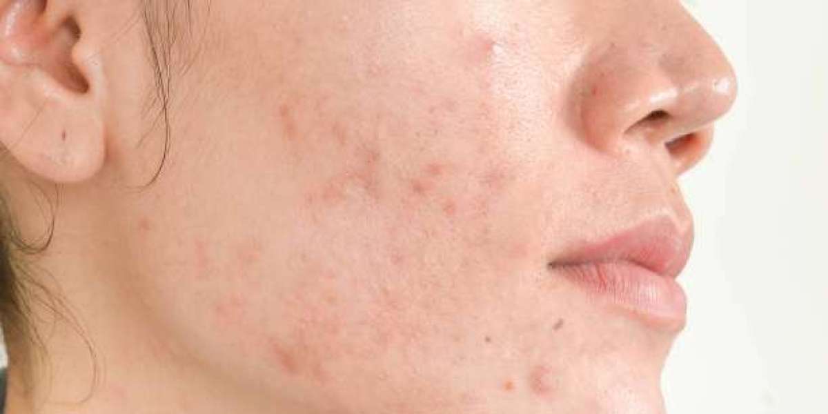 Pimples Treatment Care for Naturally Smooth Skin