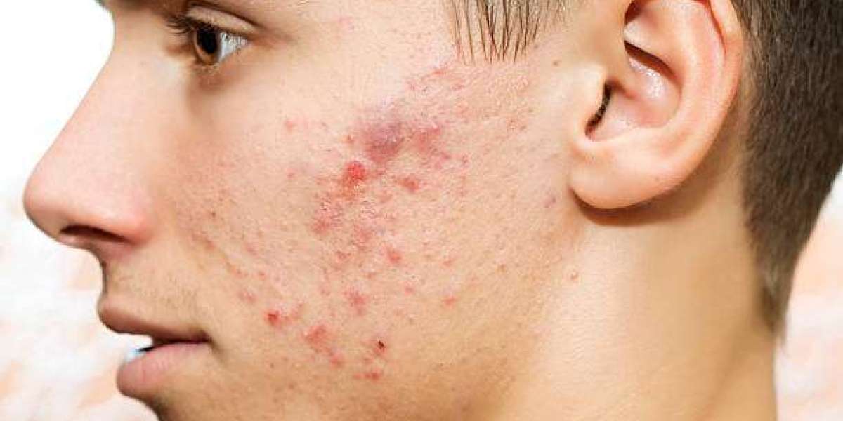 Pimples Treatment Tips for Fresh and Radiant Skin
