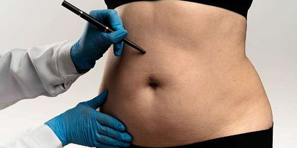How Long Do Liposuction Results Last?