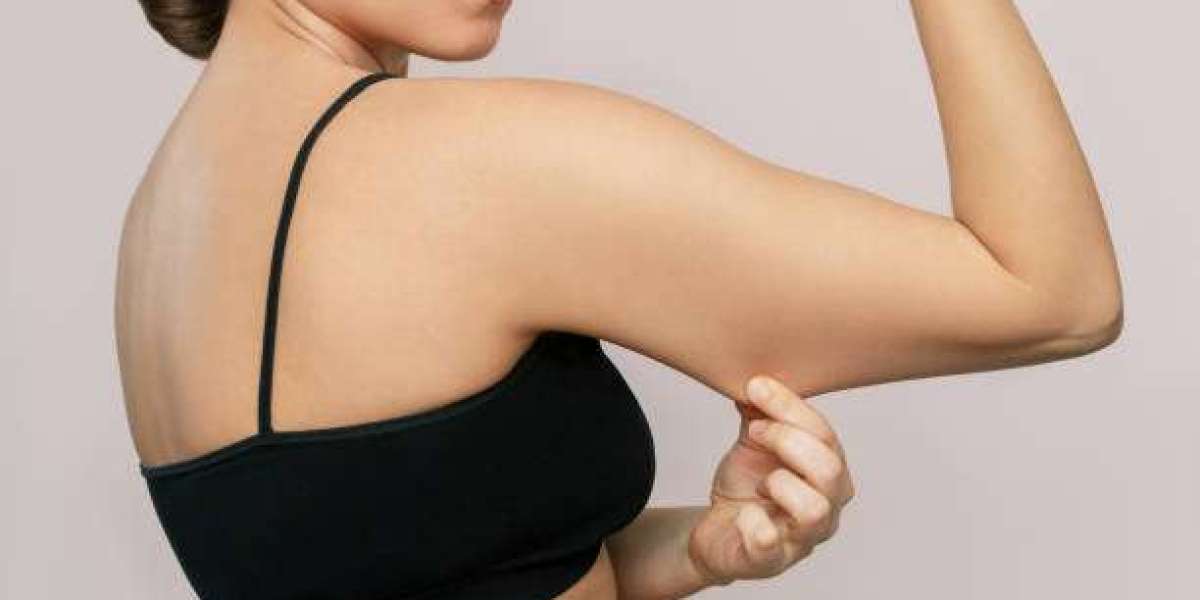 Arm Lift Surgery Scars: Where They Hide and Fade