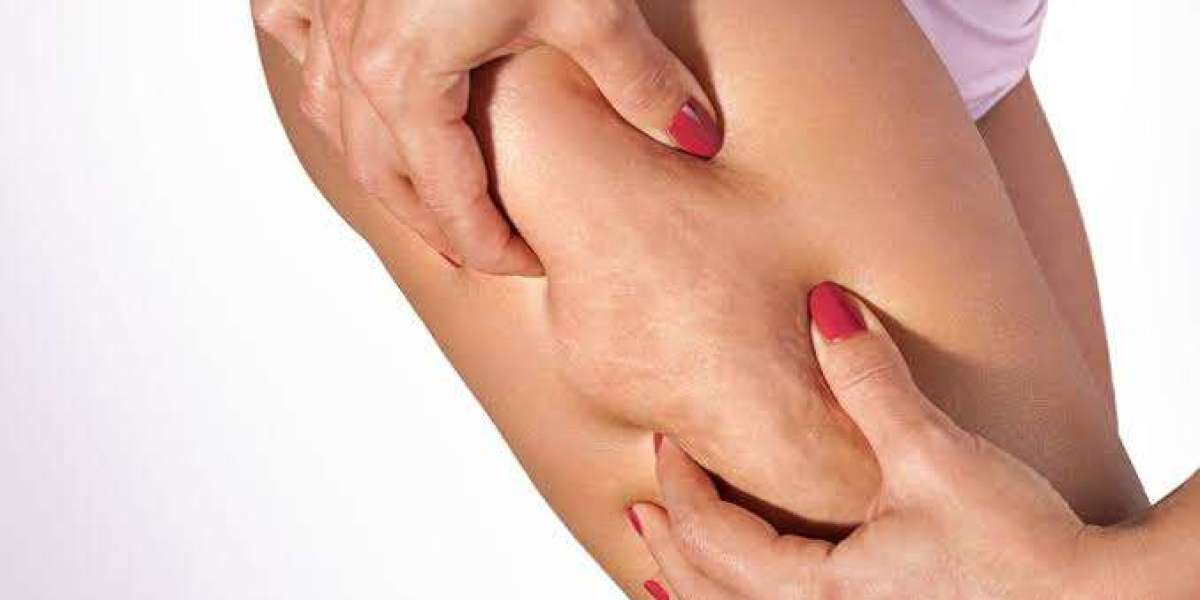Cellulite Treatment Cost: Insurance and Financing Tips