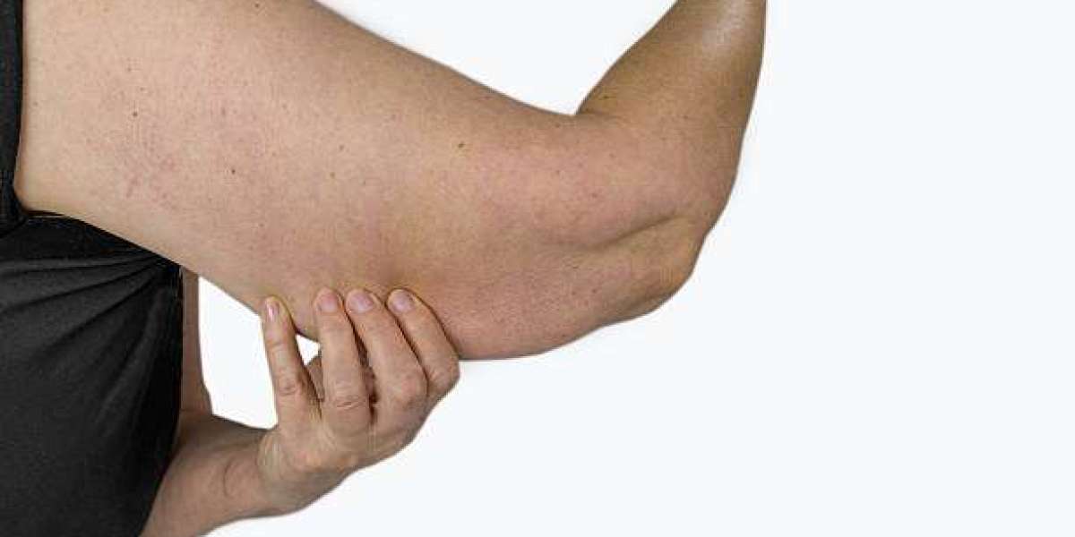 How Arm Lift Surgery Can Help Achieve Tighter, Smoother Arms in Riyadh
