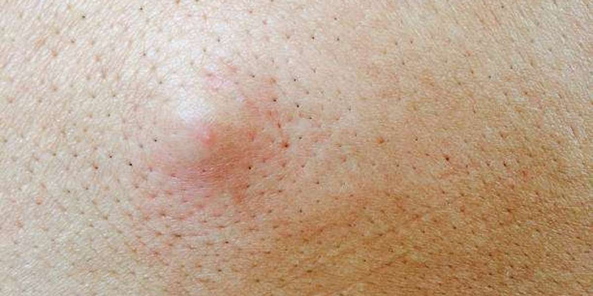 Sebaceous Cyst Removal Options for Lasting Skin Improvement