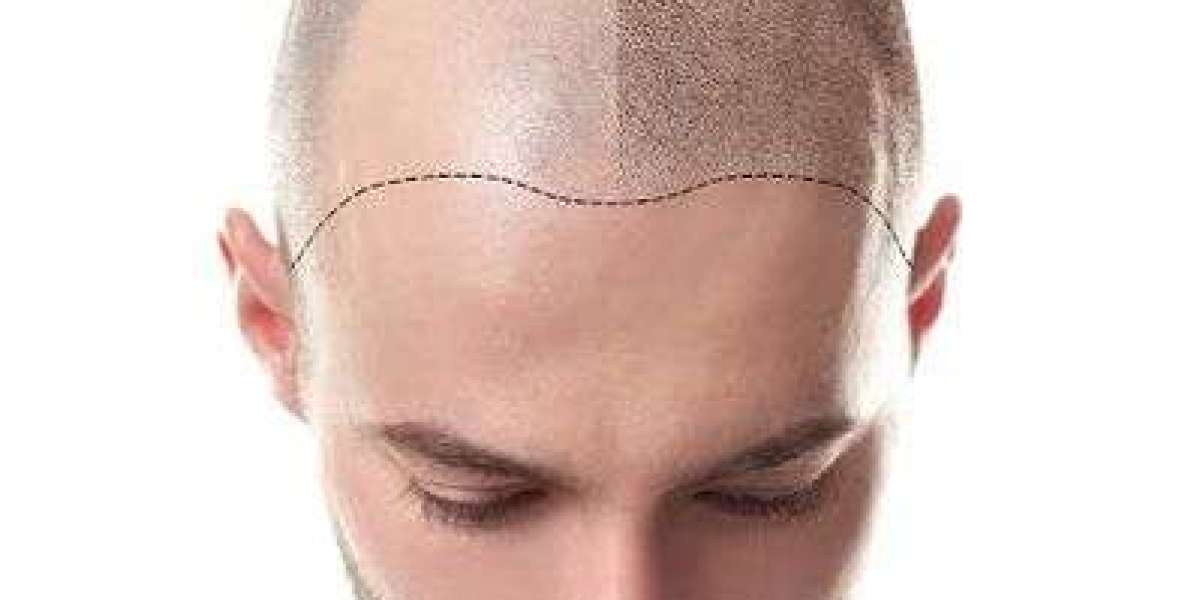 Hair Transplant in Riyadh for Natural-Looking Hairline Restoration