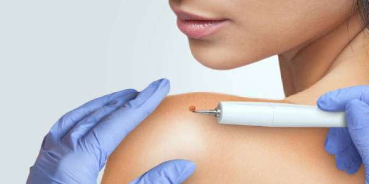 Understanding Warts Removal Methods for Lasting Skin Confidence