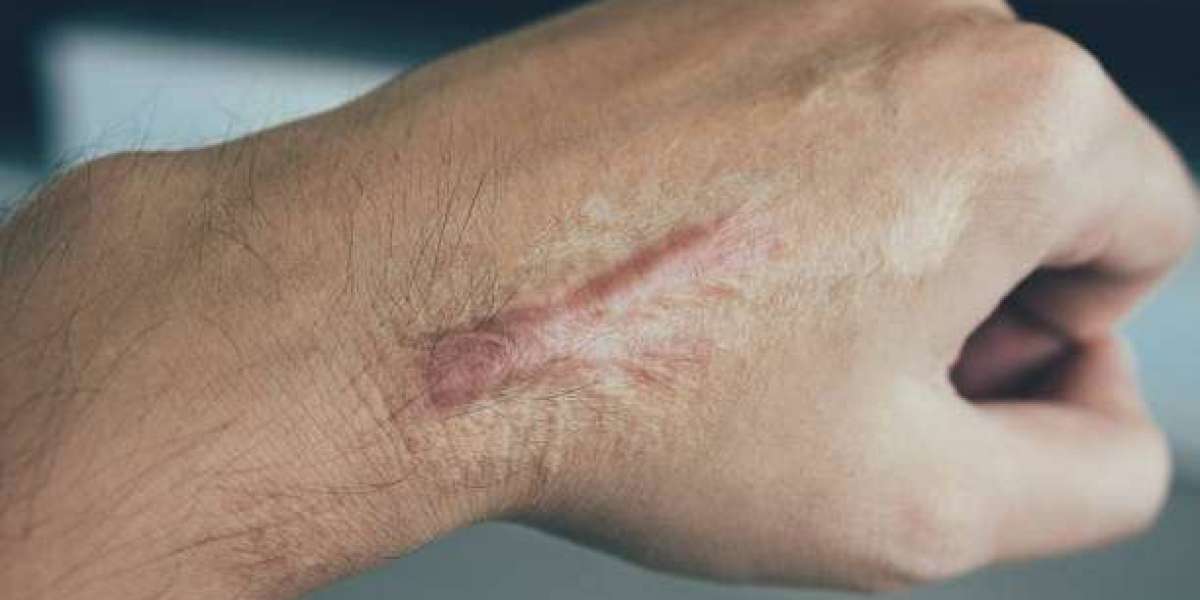 Laser Scar Removal for Fading Stubborn Scars and Skin Marks