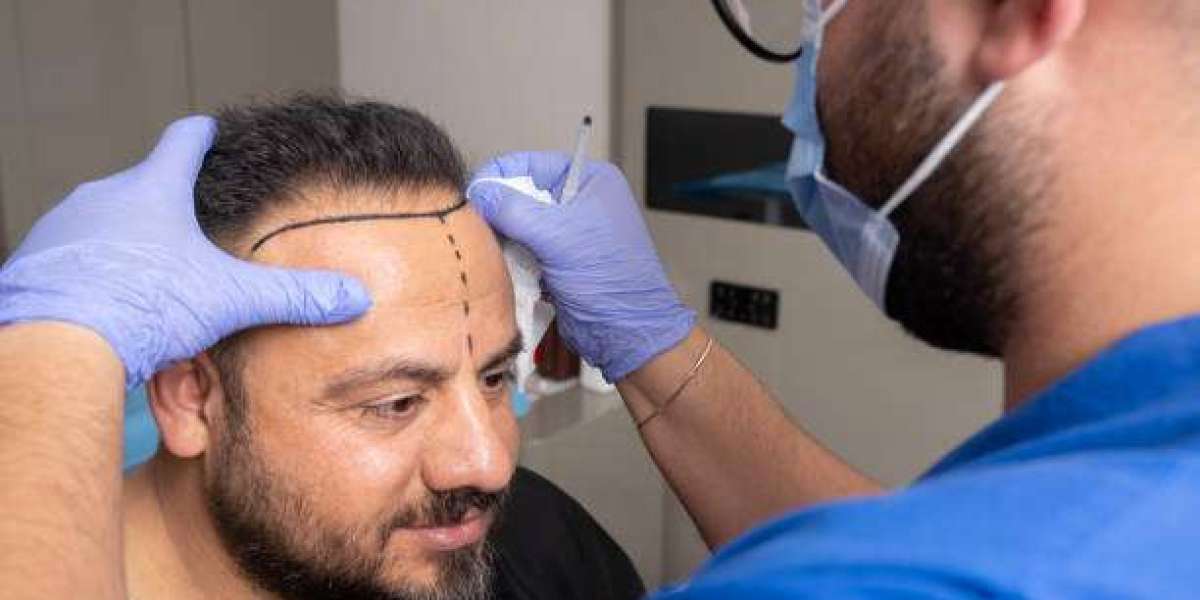 Long-Term Outcomes of Hair Transplant in Riyadh