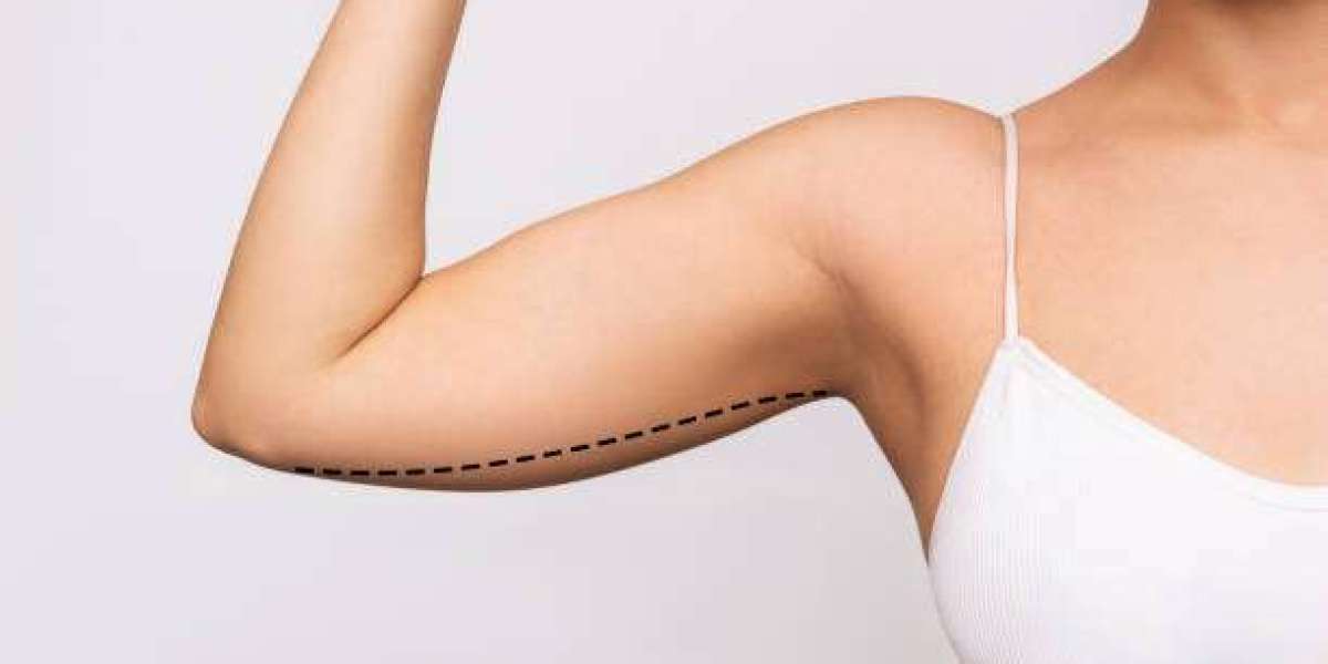 Arm Lift Surgery in Riyadh and Its Role in Comprehensive Body Shaping