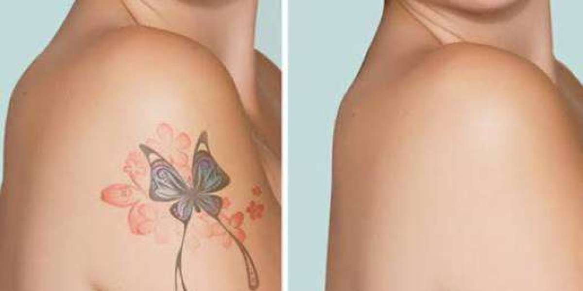 Laser Tattoo Removal in Riyadh for Different Tattoo Colors and Sizes