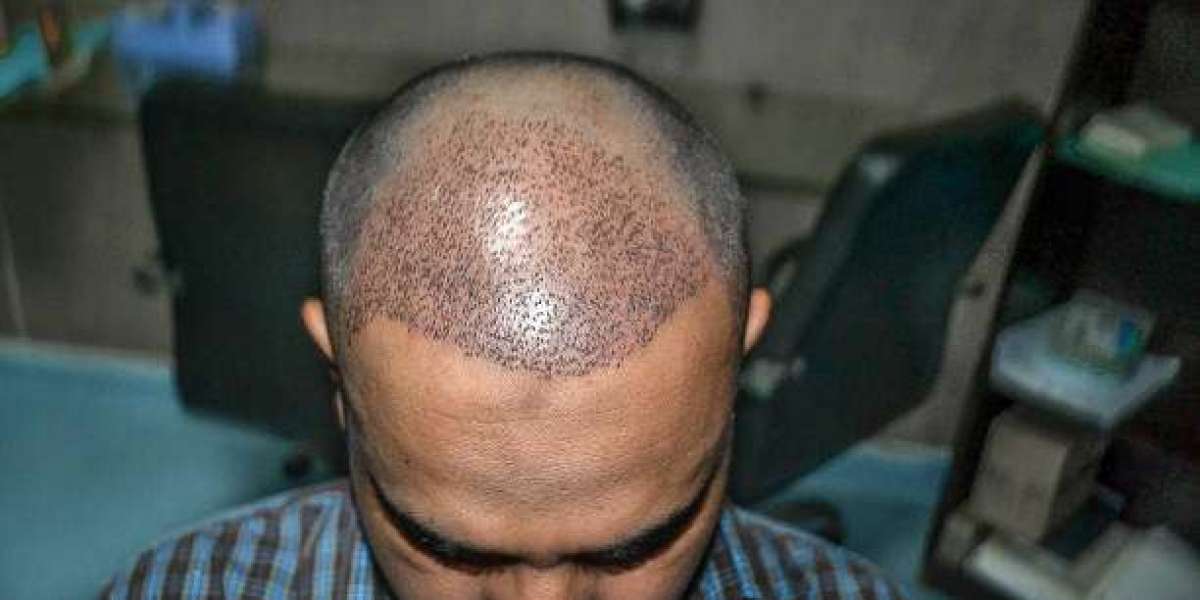 Hair Transplant Aftercare for Better Hair Restoration