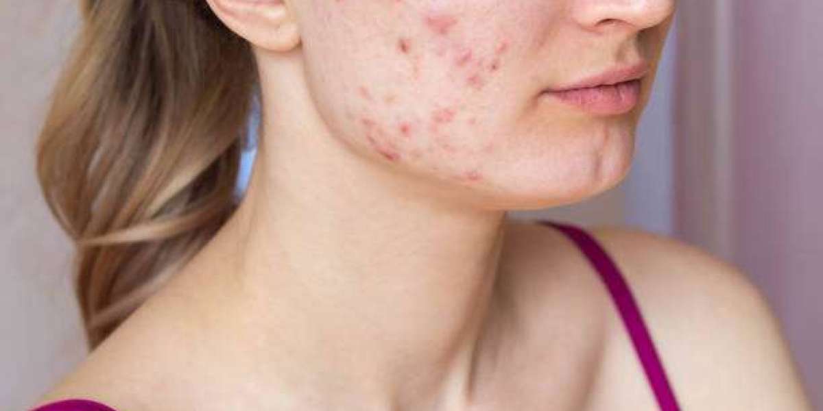 Acne Scar Treatment for Mild, Moderate, and Severe Scarring