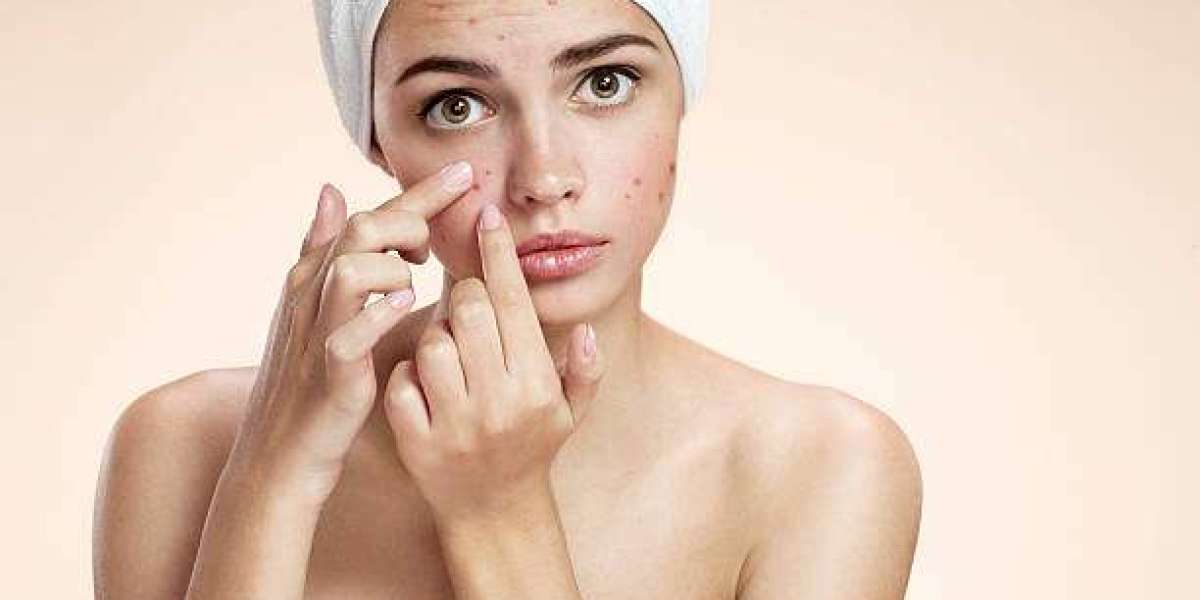 Acne Treatment for Seasonal Flare-Ups: Adjusting Your Routine