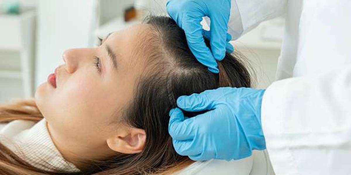 Exosomes Therapy for Hair Loss in Riyadh for Naturally Fuller Looking Results
