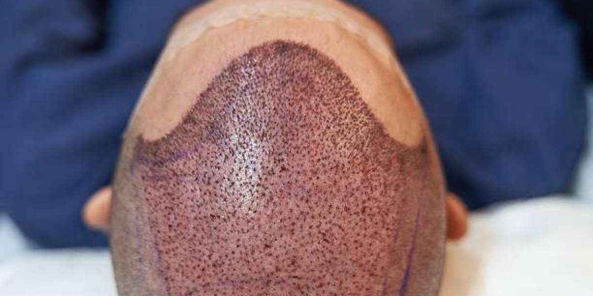 Hair Transplant Longevity: What Influences It
