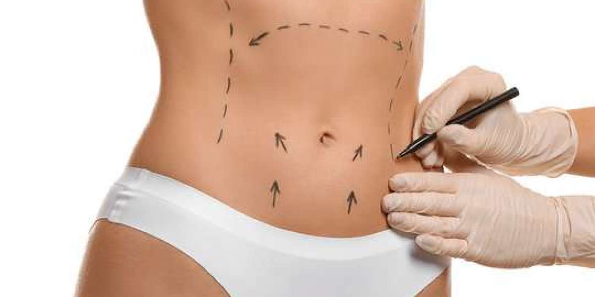 Tummy Tuck in Dubai for a Flatter, Firmer Abdomen