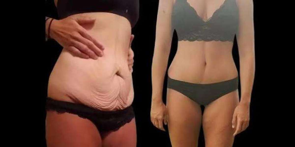 Body Contouring After Weight Loss in Dubai | Complete Guide