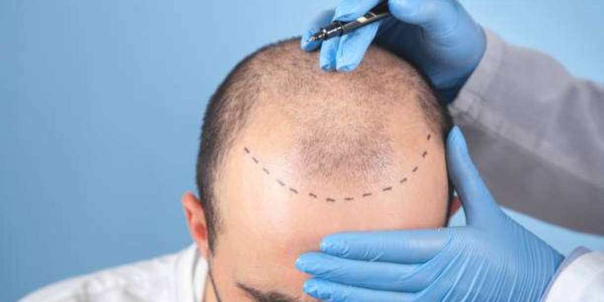 Stem Cell Hair Transplant or Medical Therapy: Key Differences