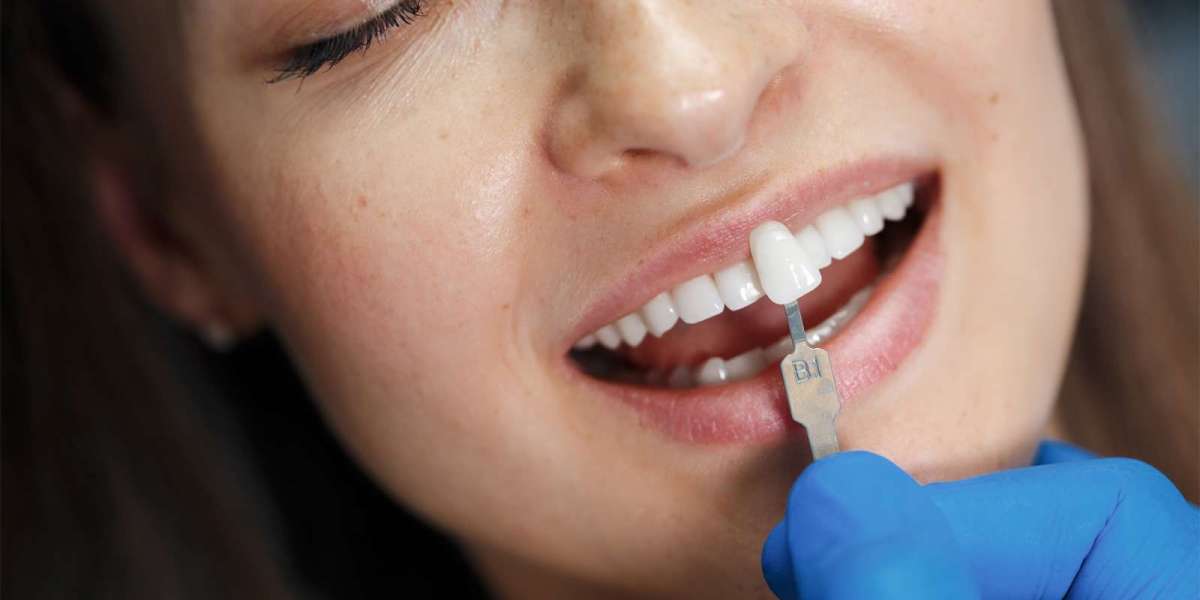 Teeth Whitening in Dubai: How the Process Works