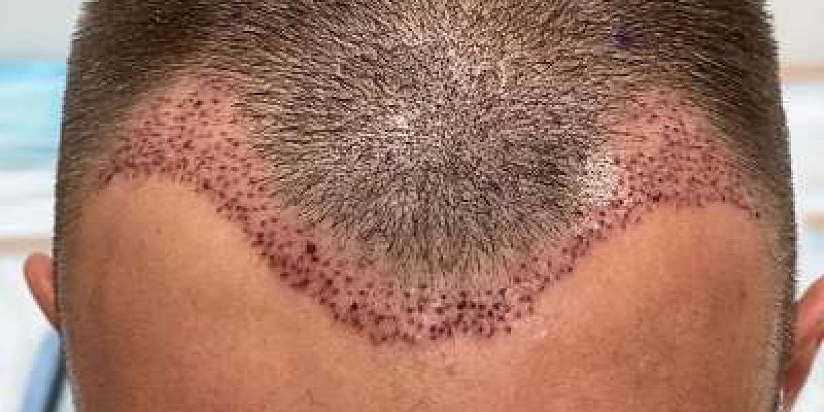 Hair Transplant in Dubai: Popular Hair Restoration Choice