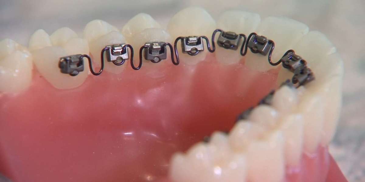 Dental Braces in Dubai: Cost and Treatment Factors