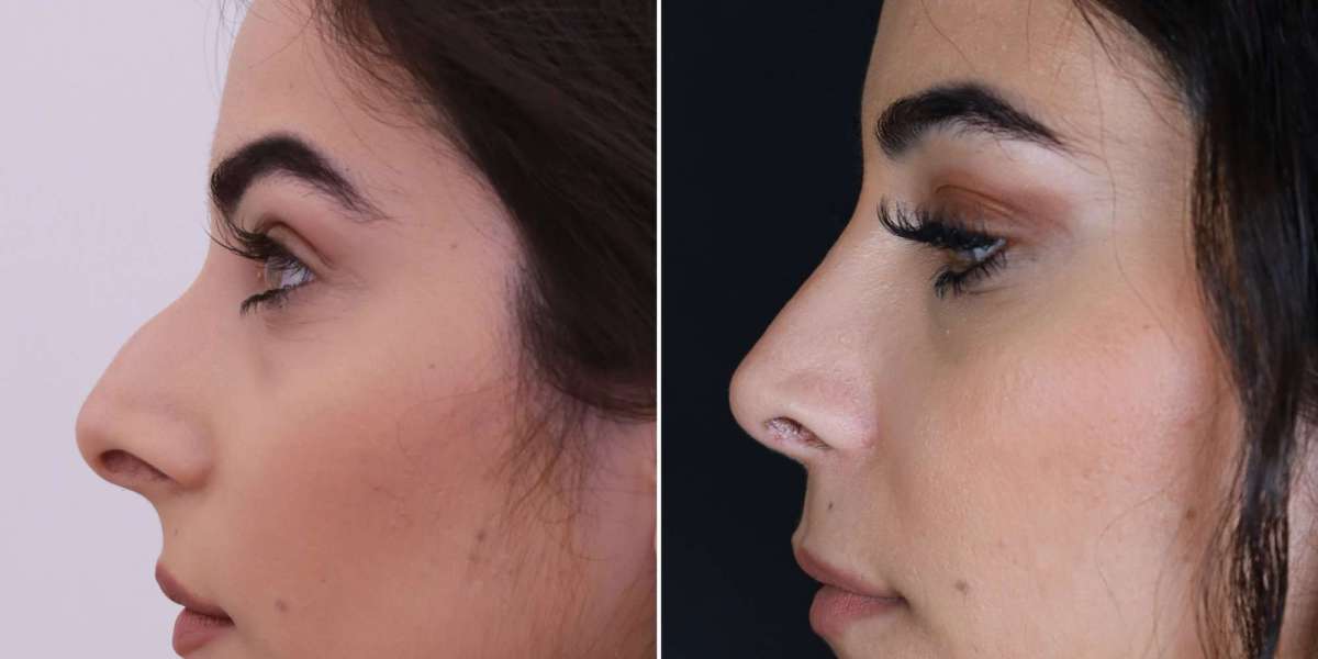 Rhinoplasty in Islamabad: Exploring Personalized Solutions for a More Balanced Facial Look
