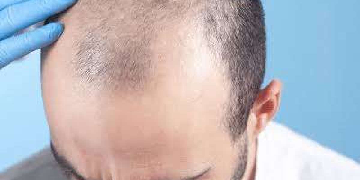 Hair Transplant in Dubai: Complete Guide to Hair Restoration