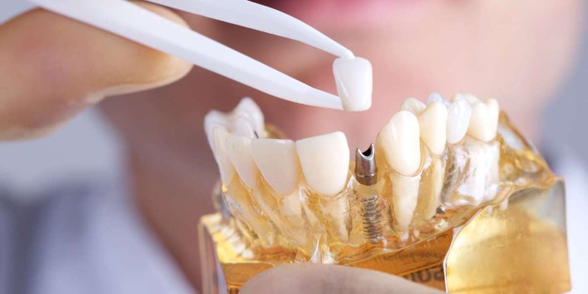 Dental Bridge Cost in Pune | Compare Types and Treatment Options