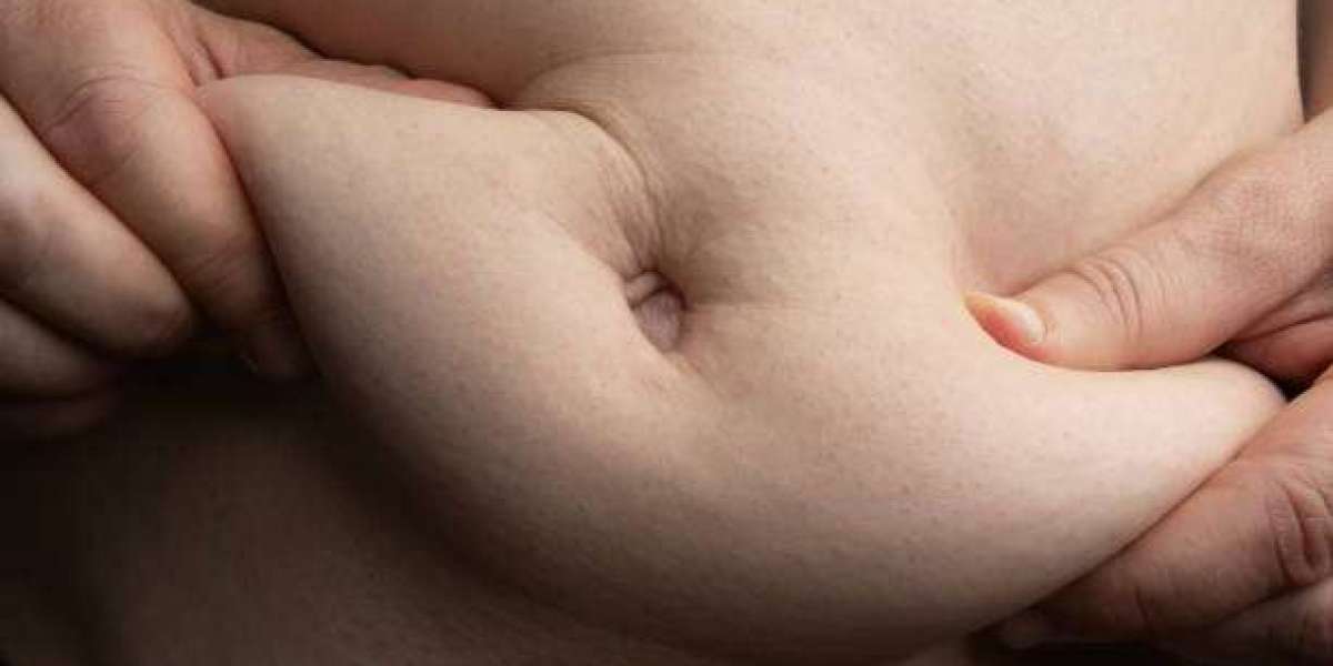 Tummy Tuck Surgical Techniques and Their Benefits in Riyadh