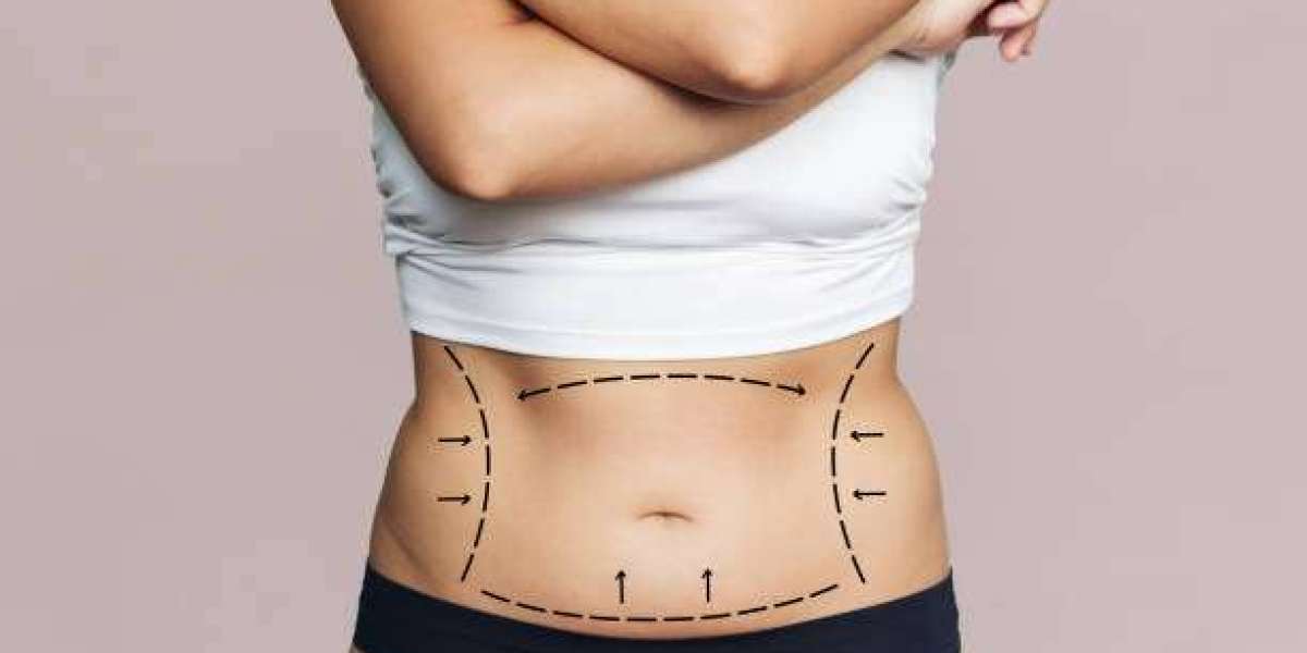 The Role of Lifestyle Changes After a Mommy Makeover in Riyadh