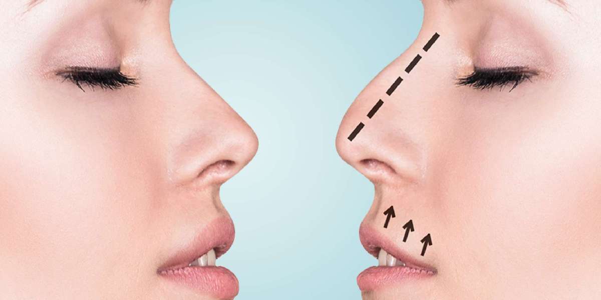 Liquid Rhinoplasty in Dubai: Non-Surgical Nose Job
