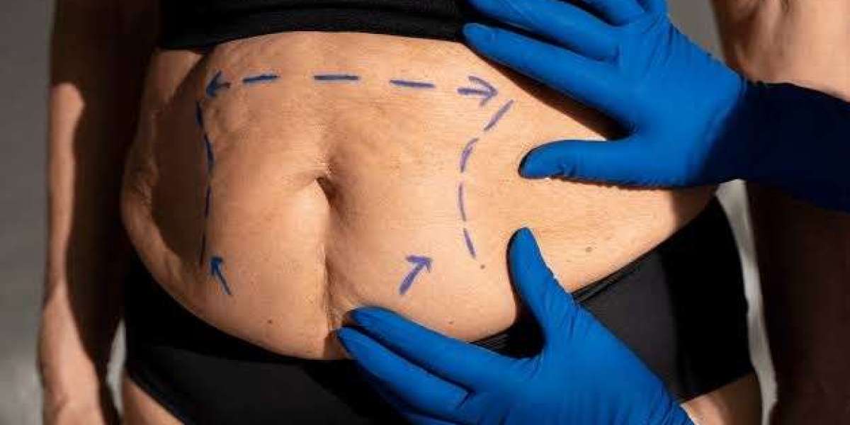 Can Liposuction Treat Belly Fat Successfully?