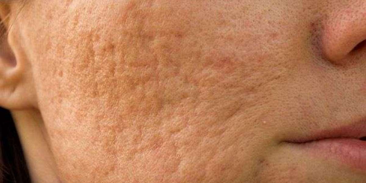 Acne scar treatment in dubai: Renew Your Skin