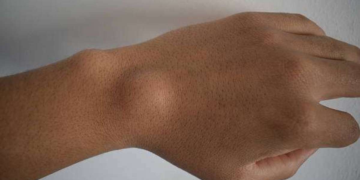 Lipoma Treatment Options for Smooth Skin Recovery