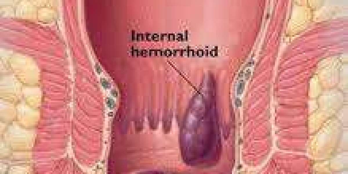 Haemorrhoids Treatment in Dubai | Symptoms, Procedures & Care
